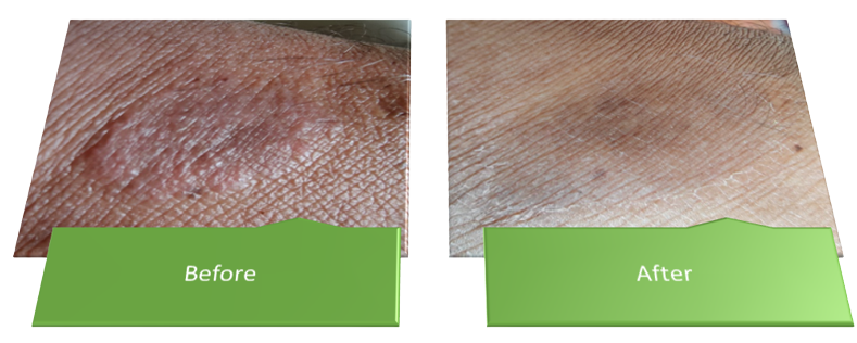 Eczema